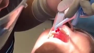 جراحی دو واحد ایمپلنت و کشیدن همزمان