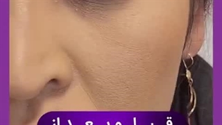 کاشت ابرو در کلینیک آوینا