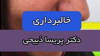 خداحافظی با خال‌های مزاحم فقط در چند دقیقه!
