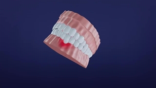 قبل از ایمپلنت، فک شما باید آماده بشه!