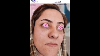 10.87 مگ از 10.87 مگ مزوژل برای آبرسانی و روشنی پوست و زیر چشم