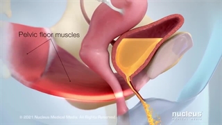 Stress Urinary Incontinence (SUI)