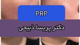 نتیجه‌ی پی آر پی (PRP) برای تقویت و جوانسازی پوست