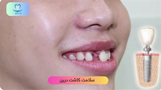 کاشت ایمپلنت برای دندان جلو |سلامت کاشت درین
