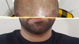 کاشت مو تخصصی سارا دهشیری