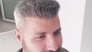 نمونه کاشت مو