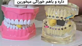 عشق واقعی اونجاست که با ارتودنسی بخوای باهاش خوراکیت رو نصف کنی