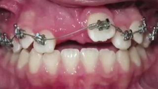 بیرون کشیدن دندان نهفته با ارتودنسی و پروسه اش رو توی این فیلم میبینید