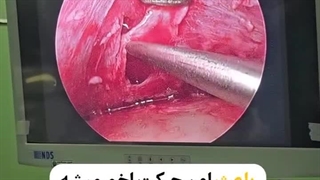 درمان سردرد سینوسی