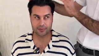 نمونه کاشت عالی مو