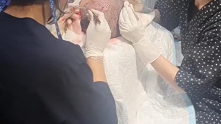 فیلم کاشت مو آقایان