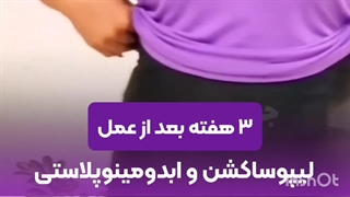 عکس قبل و بعد از عمل ابدومینوپلاستی و لیپوساکشن در مشهد