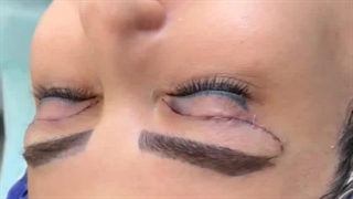 بلفاروپلاستی و جوانسازی دقیق ناحیه پلک