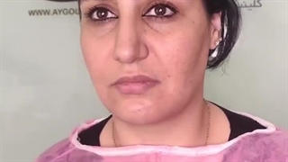 نمونه کاشت ابروی کلینیک زیبایی آی گل