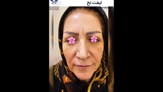 انجام لیفت صورت با نخ (6)