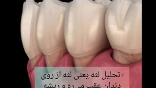 لثه تحلیل رفته بعد از کامپوزیت غیر اصولی | دکتر سمانه شیرانی