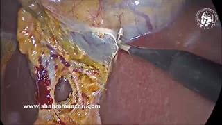 ورید کیسه صفرا که به بستر کبد تخلیه می‌شود: یک مورد کوله‌سیستکتومی لاپاروسکوپی