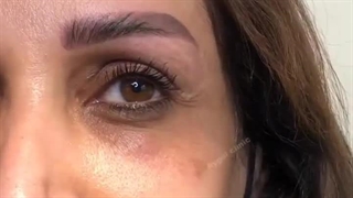 ترمیم کم‌پشتی ابرو با روش‌های دقیق و ایمن آی گل