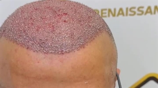 به روزترین روش کاشت موی سر در ایران