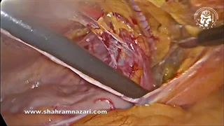 گرفتن دو مجرم در یک قاب دوربین: لیپوم طناب + ساک فتق غیر مستقیم