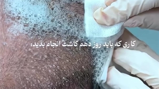 کاشت مو در اصفهان، کلینیک تخصصی آفتاب