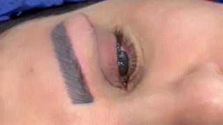 اصلاح افتادگی پلک بالا در کلینیک زیبایی رنسانس