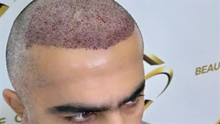 کاشت مو با بالاترین تراکم در کلینیک زیبایی رنسانس