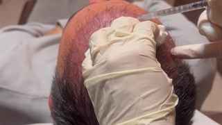 مزوتراپی فیوژن و پی ار پی کلینیک تخصصی آفتاب 09133691289