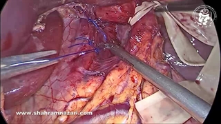 جراحی کروروپلاستی در هندسه جراحی ضد ریفلاکس فقط بخیه نیست