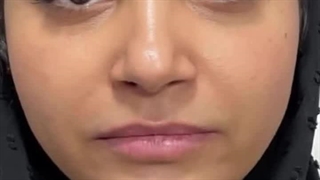 بهترین مرکز تزریق لب در فردیس