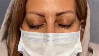 کاشت ابروهای طبیعی و جذاب، راز زیبایی صورت شما