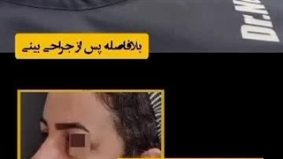 بلافاصله پس از جراحی بینی (دکتر ندا سخی)