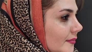 یک سال و نیم بعد از جراحی بینی