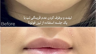 لیفت لب