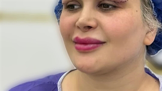 انجام بلفاروپلاستی با بخیه لیزری