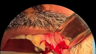 جراحی ایمپلنت دندان در تهران توسط دکتر حمید پورصادقی