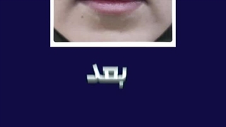 تغییری هیجان انگیز فقط با یک سی سی فیلر برای لب های مراجعه کننده عزیزمون