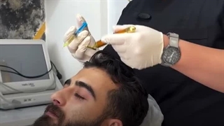 مزوتراپی + پی آر پی