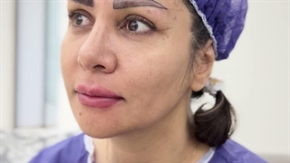 کاشت ابرو با جدیدترین تکنیک در کلینیک سینا