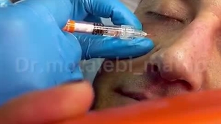 تزریق فیلر الیاکسین زیر چشم | روشی برای رفع گودی و جوانسازی چهره