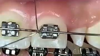 آماده‌سازی برای اصلاح موقعیت فک