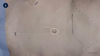 7 Abdominal Wall Incision - Midline
