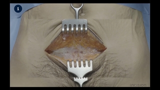 10 Abdominal Wall Incision - Pfannenstiel