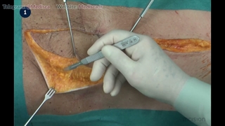 14 Rectus Abdominis Musculocutaneous Flap
