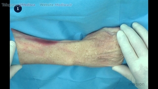 19 Z-Plasty