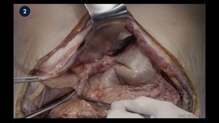 30 Open Antegrade Cholecystectomy