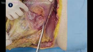 33 Open Distal Pancreaticosplenectomy