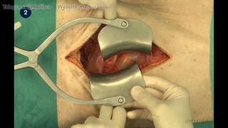 47 Open Partial Gastrectomy - BII Reconstruction