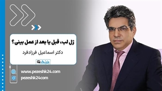 بهترین زمان تزریق ژل لب؛ قبل از عمل بینی یا بعد از آن؟ - پزشک 24