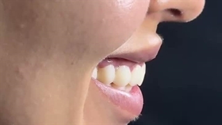 ایمپلنت کامل فک با روکش در یک روز